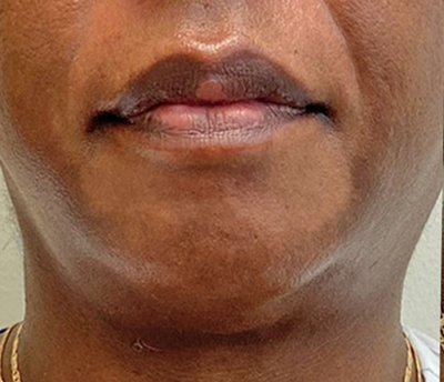 Morpheus8