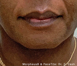 Morpheus8