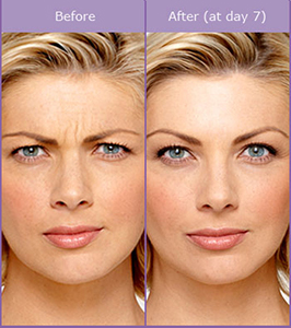 Botox Before and After Photos | Eberbach Plastic Surgery