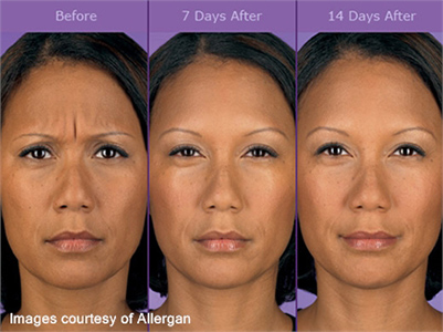 Botox Before and After Photos | Eberbach Plastic Surgery