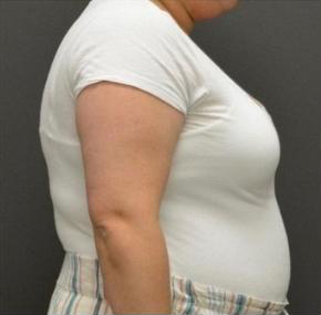 Advanced Weight Loss