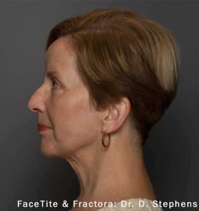 Facetite