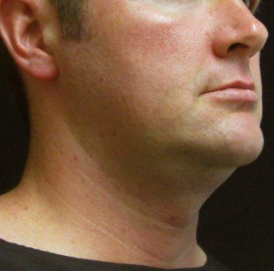 Facetite