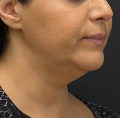 Facetite