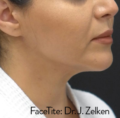 Facetite