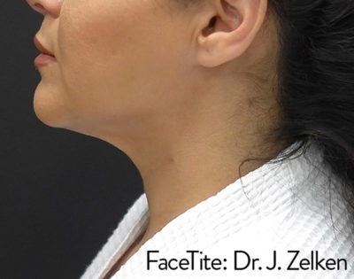 Facetite