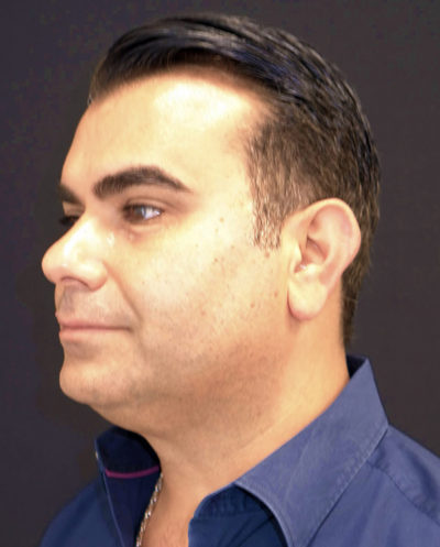 Facetite