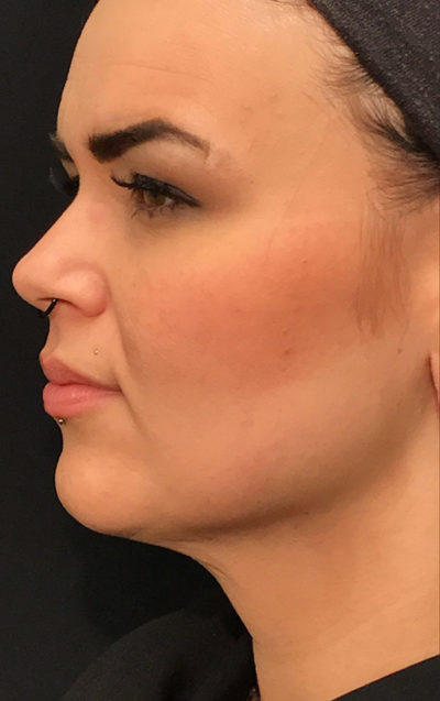 Facetite