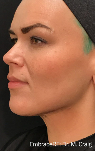 Facetite