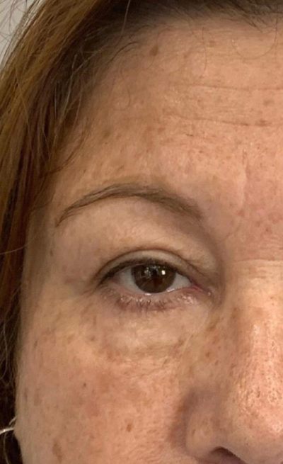 Facetite