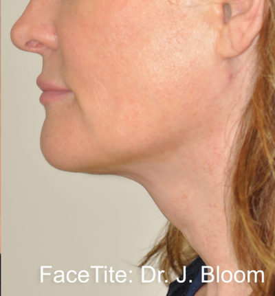 Facetite