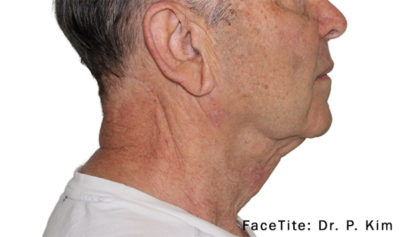Facetite