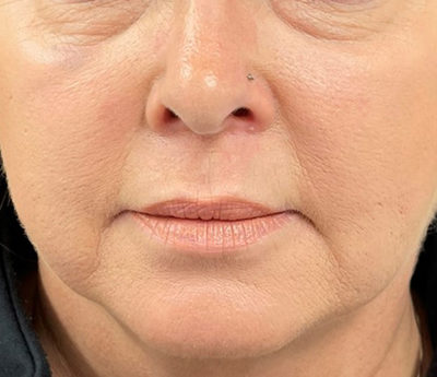 Facetite