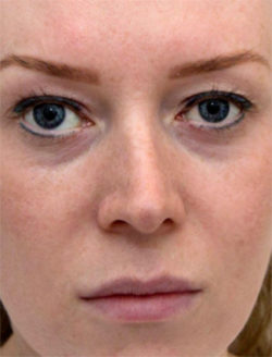 The Perfect Derma Peel