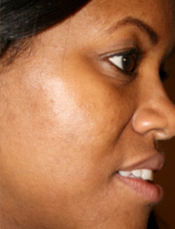 The Perfect Derma Peel