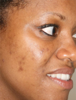 The Perfect Derma Peel
