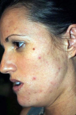 The Perfect Derma Peel