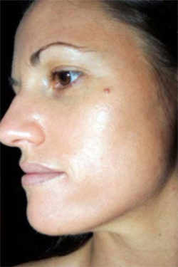 The Perfect Derma Peel