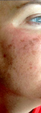The Perfect Derma Peel