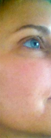 The Perfect Derma Peel