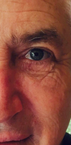 The Perfect Derma Peel