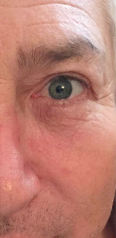 The Perfect Derma Peel