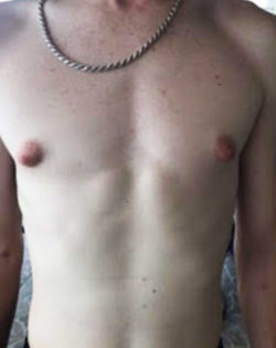 Gynecomastia