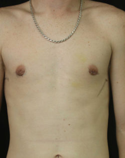Gynecomastia