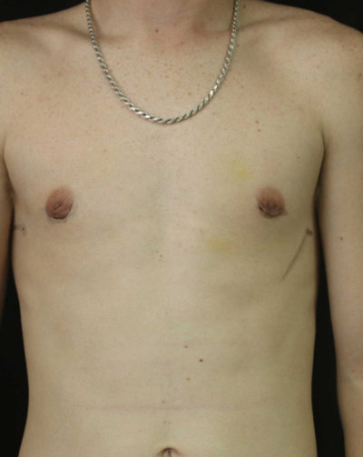 Gynecomastia