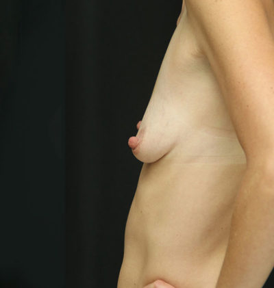 Breast Augmentation - 300cc and under