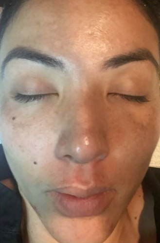 The Perfect Derma Peel