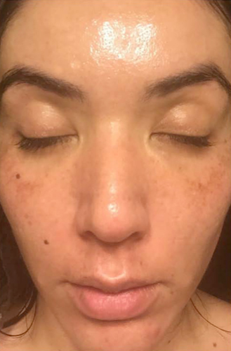 The Perfect Derma Peel