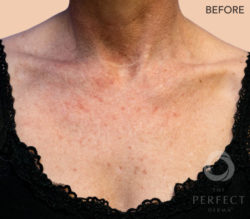 The Perfect Derma Peel