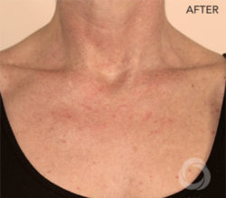 The Perfect Derma Peel