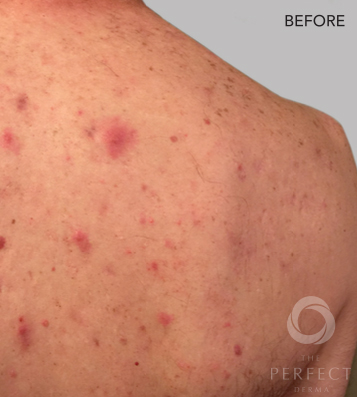 The Perfect Derma Peel