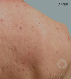 The Perfect Derma Peel
