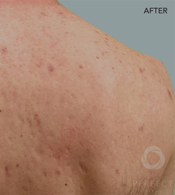 The Perfect Derma Peel