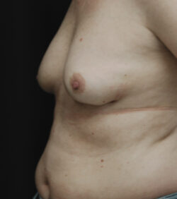 Breast Implant Removal