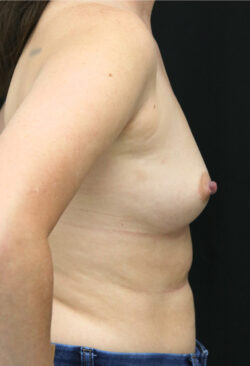 Breast Augmentation - 300cc-399cc