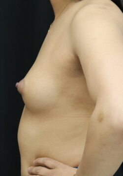 Breast Augmentation - 400cc-499cc
