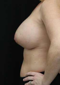 Breast Implant Exchange